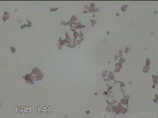 右侧甲状腺细针穿刺涂片图18