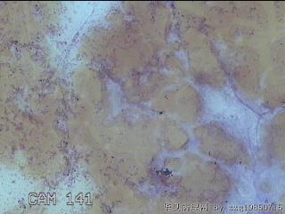 右侧甲状腺细针穿刺涂片图16