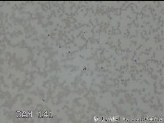 右侧甲状腺细针穿刺涂片图2