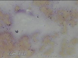 右侧甲状腺细针穿刺涂片图4