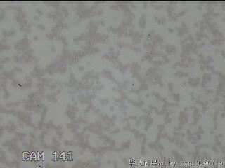 右侧甲状腺细针穿刺涂片图25