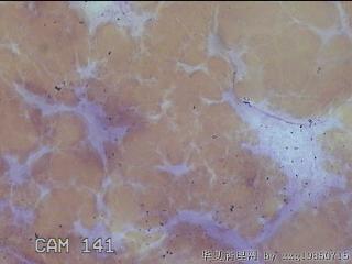 右侧甲状腺细针穿刺涂片图14