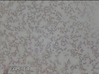 右侧甲状腺细针穿刺涂片图29