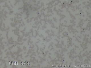 右侧甲状腺细针穿刺涂片图24