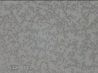 右侧甲状腺细针穿刺涂片图27