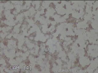右侧甲状腺细针穿刺涂片图30