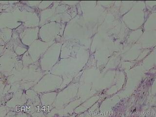 后颈部包块图23