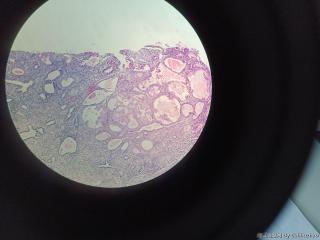 子宫内膜息肉，息肉内腺体有粘液改变伴微乳头状结构？图2