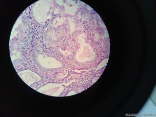 子宫内膜息肉，息肉内腺体有粘液改变伴微乳头状结构？图1