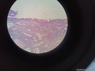 子宫内膜息肉，息肉内腺体有粘液改变伴微乳头状结构？图4