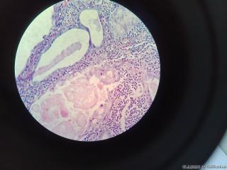 子宫内膜息肉，息肉内腺体有粘液改变伴微乳头状结构？图8