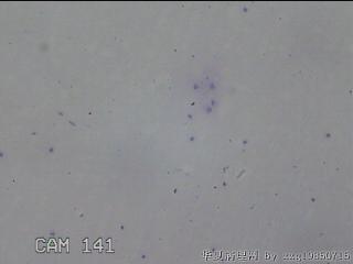 膝关节积液14ml图21