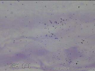 膝关节积液14ml图18