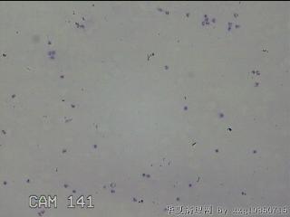 膝关节积液14ml图17