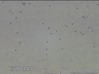 膝关节积液14ml图2