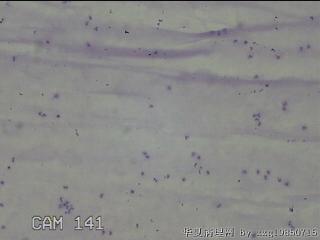 膝关节积液14ml图4