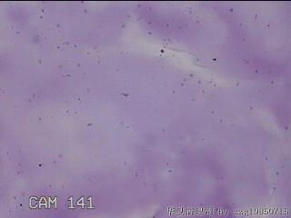膝关节积液14ml图16