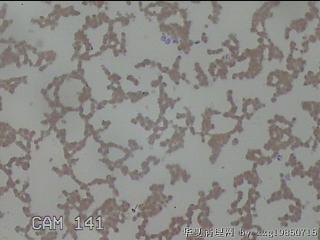 左侧甲状腺细针穿刺涂片图14