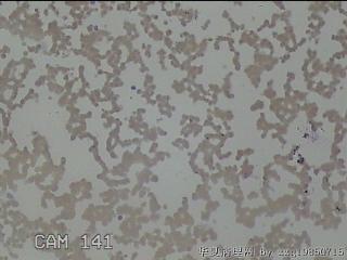左侧甲状腺细针穿刺涂片图12