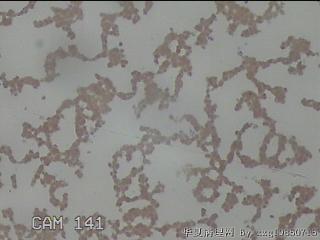 左侧甲状腺细针穿刺涂片图15