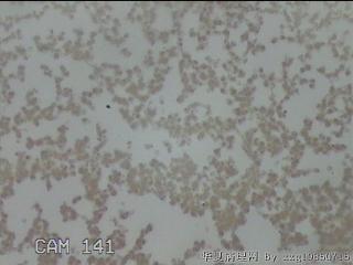 左侧甲状腺细针穿刺涂片图1