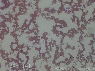 左侧甲状腺细针穿刺涂片图11