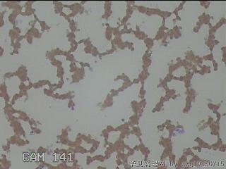 左侧甲状腺细针穿刺涂片图17