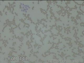 左侧甲状腺细针穿刺涂片图6