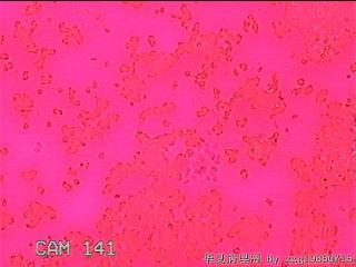甲状腺细针穿刺涂片图17