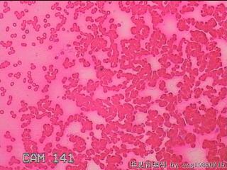 甲状腺细针穿刺涂片图27