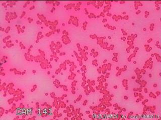 甲状腺细针穿刺涂片图24