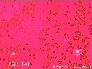 甲状腺细针穿刺涂片图12