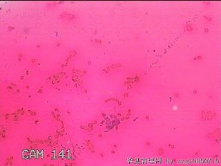 甲状腺细针穿刺涂片图19