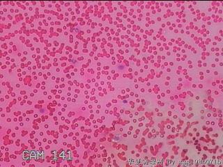 右侧甲状腺细针穿刺涂片图7