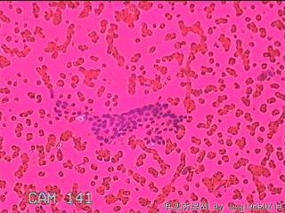 左侧甲状腺细针穿刺涂片图18