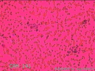 左侧甲状腺细针穿刺涂片图26