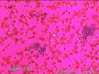左侧甲状腺细针穿刺涂片图13