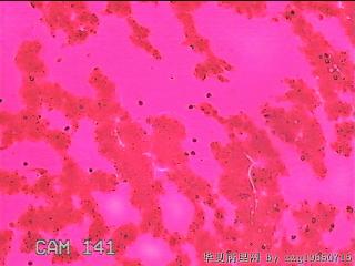右侧甲状腺细针穿刺涂片图5