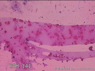 左侧下甲状腺细针穿刺涂片图22