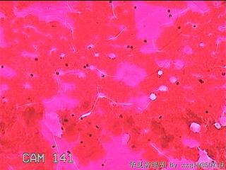 右侧甲状腺细针穿刺涂片图3