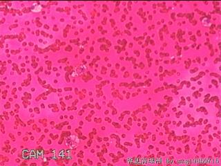 右侧甲状腺细针穿刺涂片图12