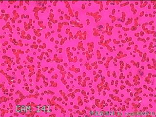 右侧甲状腺细针穿刺涂片图8