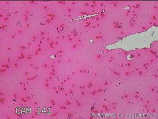 左侧下甲状腺细针穿刺涂片图11