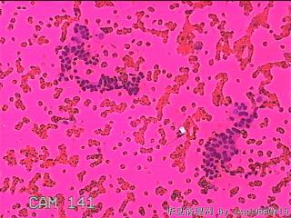 左侧甲状腺细针穿刺涂片图14
