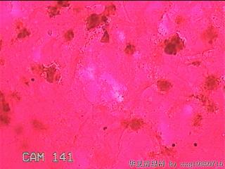 左侧下甲状腺细针穿刺涂片图14
