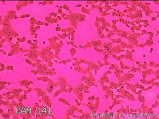 左侧甲状腺细针穿刺涂片图2