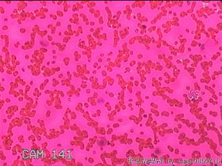 右侧甲状腺细针穿刺涂片图9