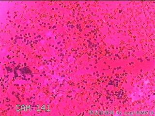 右侧甲状腺细针穿刺涂片图30