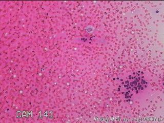 右侧甲状腺细针穿刺涂片图21