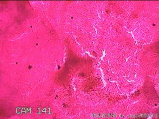 左侧下甲状腺细针穿刺涂片图12